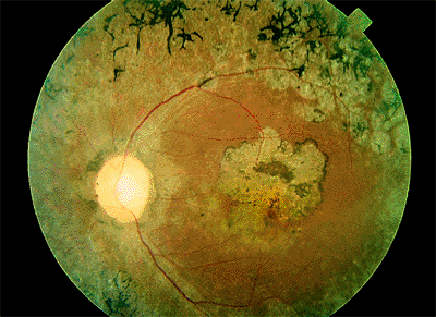 4 - Vitreoretinal Disorders | The Wills Eye Hospital Atlas of Clinical